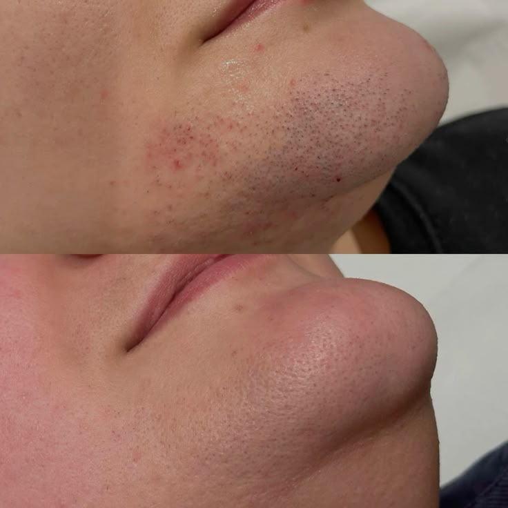 Antes e depois de depilação a laser no queixo