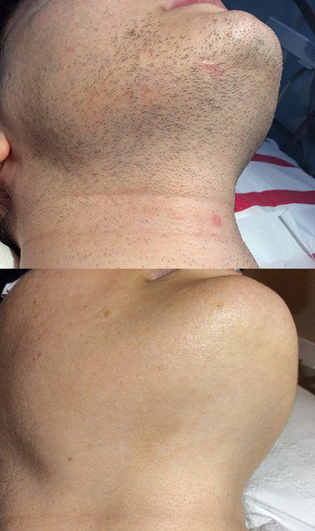 Antes e depois de depilação a laser no pescoço
