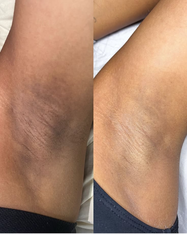 Antes e depois de depilação a laser na axila