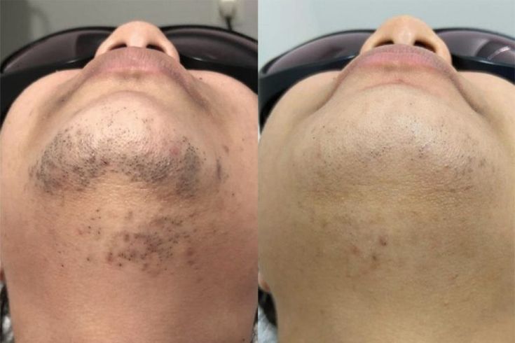 Antes e depois de depilação a laser no buço
